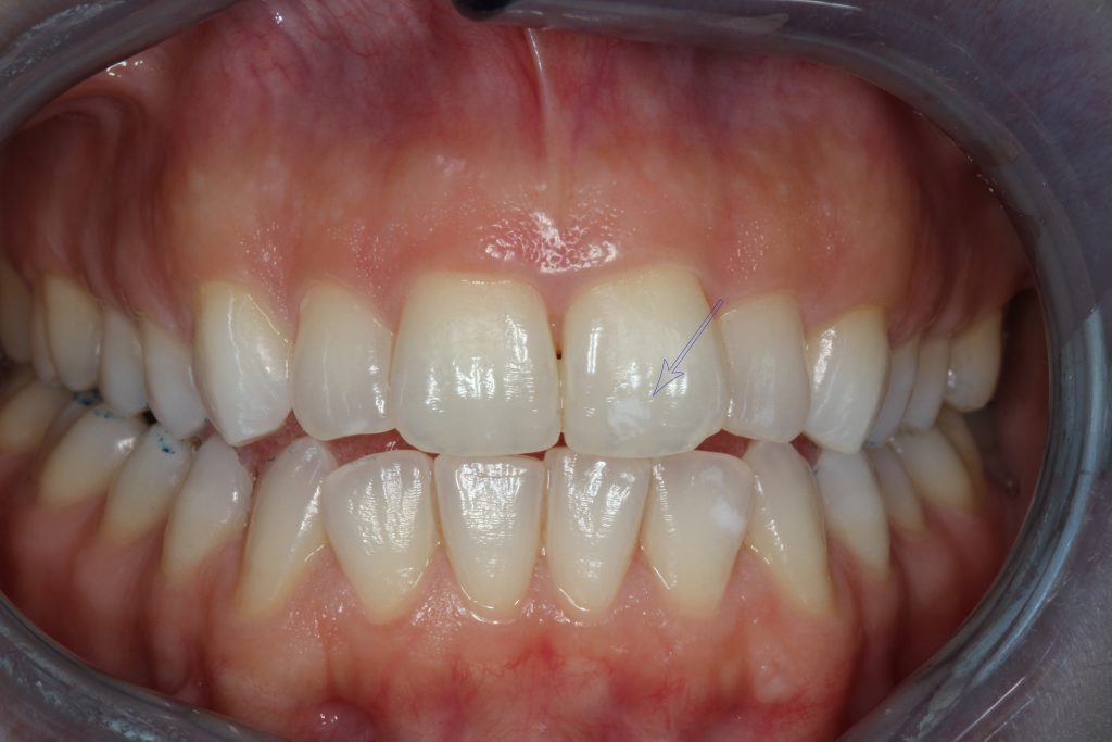 Microabrasion / Bonding Case study Ι Malamis Dental